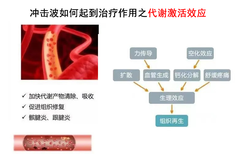 冲击波机器人——疼痛科特色治疗