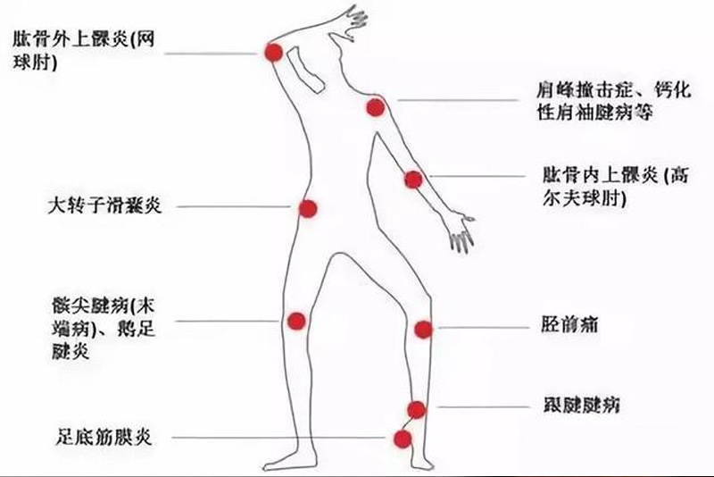 冲击波机器人康复技术--不流血的手术刀